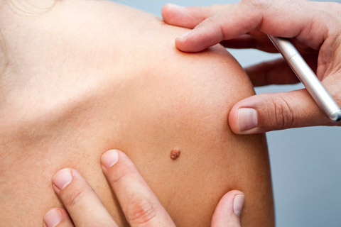 Lunares y diagnóstico precoz de cáncer de piel