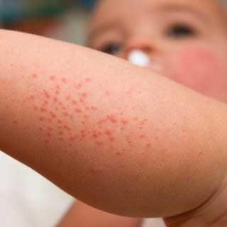 dermatitis-atopica