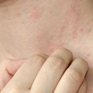 dermatitis-de-contacto