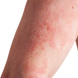 psoriasis